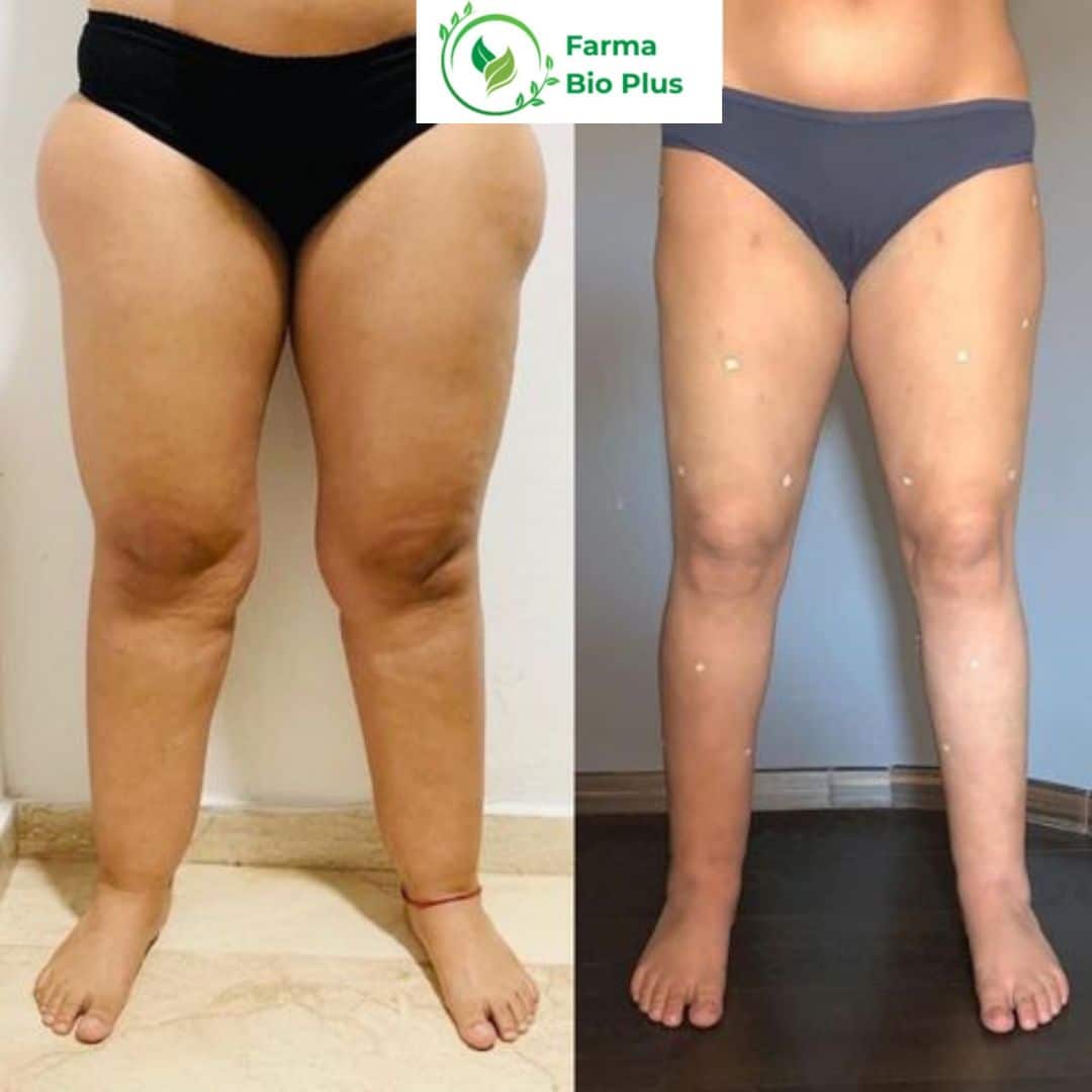 Risultato lipedema gambe prima e dopo RitenDren