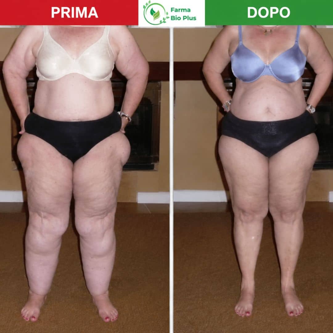Risultato lipedema gambe prima e dopo RitenDren