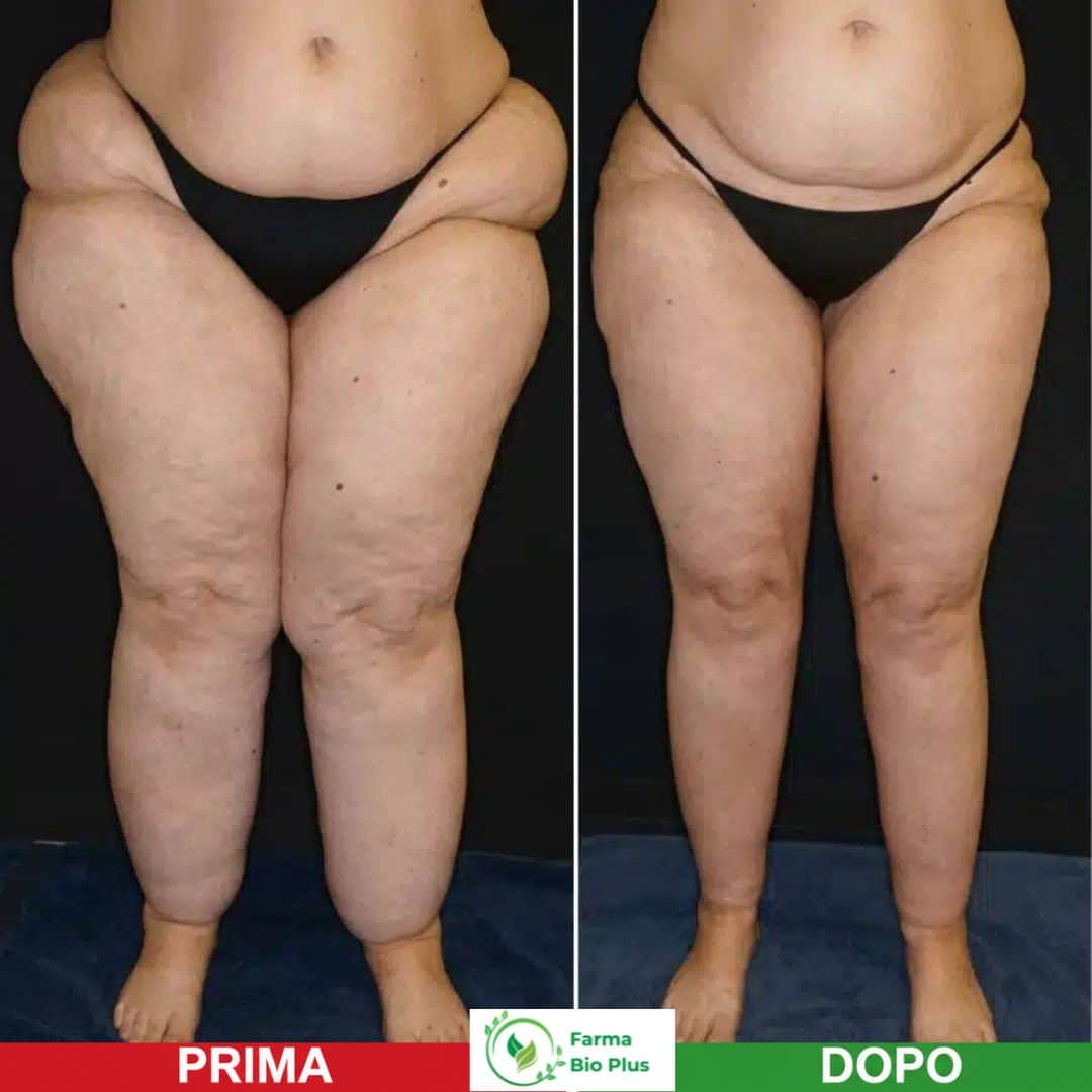 Risultato lipedema gambe prima e dopo RitenDren